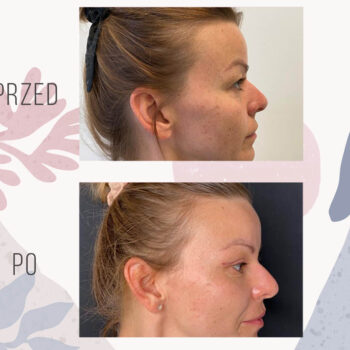 efekt po blefaroplastyce powiek