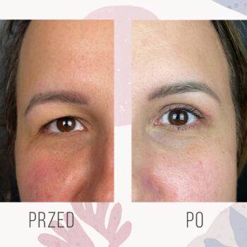efekt blefaroplastyki powiek