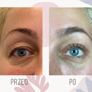 efekt po operacji powiek