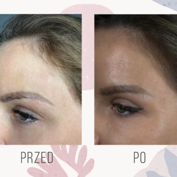 efekt po plastyce powiek