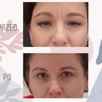 korekta opadających powiek