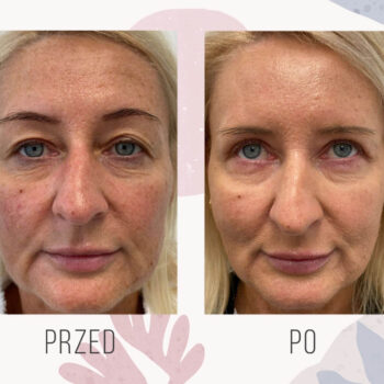 korekta powiek górnych efekt przed i po