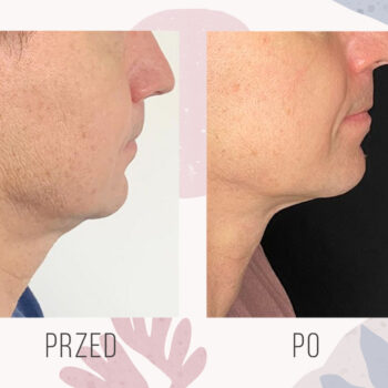 efekt przed i po liposukcji podbródka