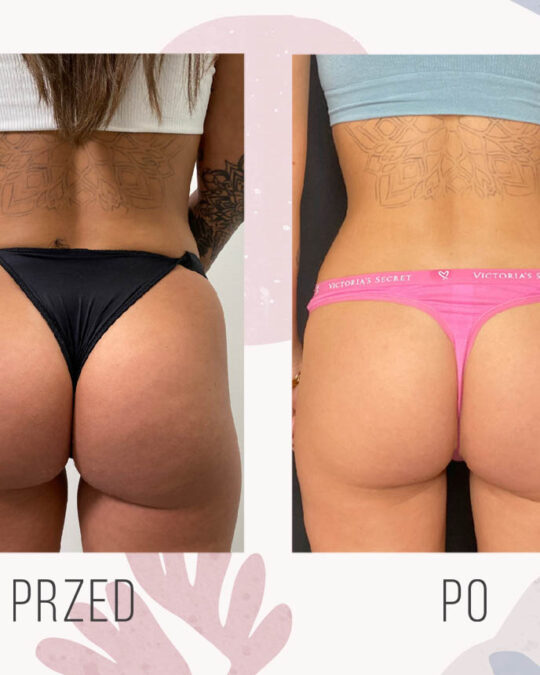 liposukcja posladkow modelowanie posladkow