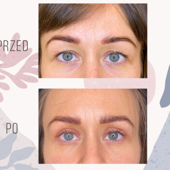 efekt po zabiegu korekty powiek