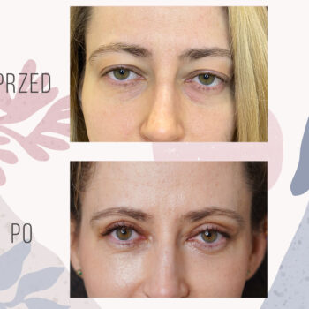 efekt po zabiegu plastyki powiek