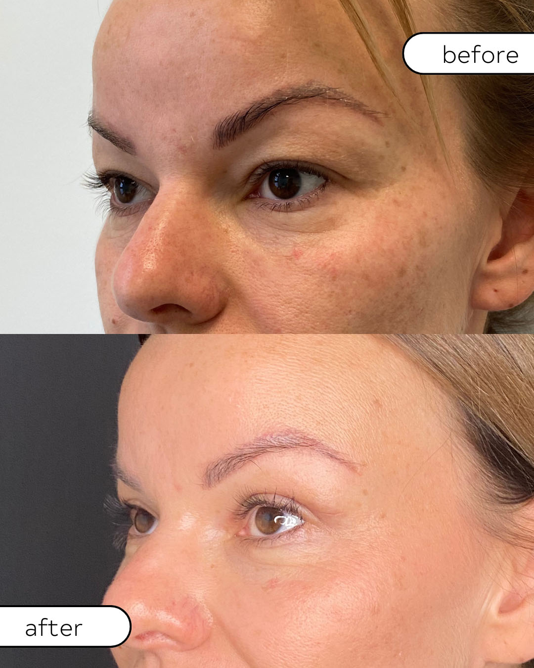 Metamorfoza po plastyce powiek górnych – usunięcie ciężkości spojrzenia i wiotkości skóry, przed i po w Klinice OT.CO