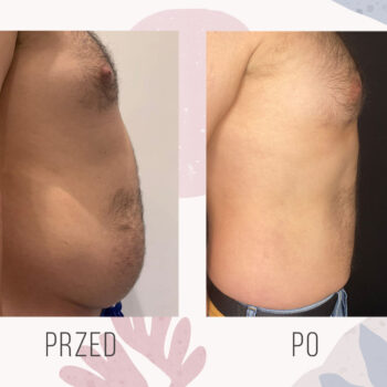 efekt po zabiegu usunięcia ginekomastii