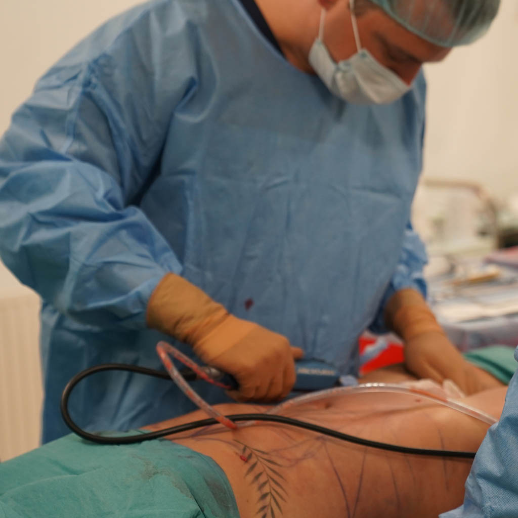 dr piotr turkowski podczas liposukcji