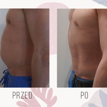 usunięcie ginekomastii metodą liposukcji