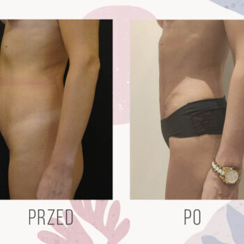 efekt odessania tłuszczu metodą liposukcji