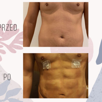efekt przed i po liposukcji ultradźwiękowej brzucha
