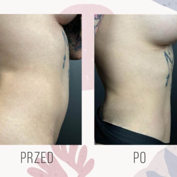 liposukcja brzucha kobieta