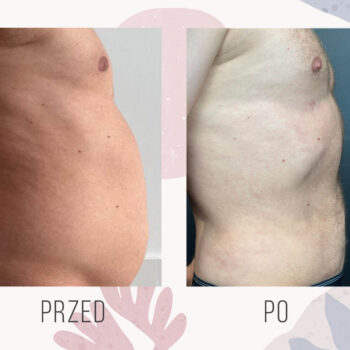 liposukcja brzucha mezczyzna