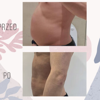 modelowanie brzucha u mężczyzny vaser lipo