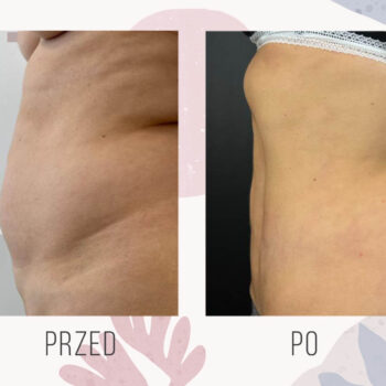 liposukcja efekt plaski brzuch