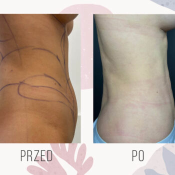 liposukcja efekt