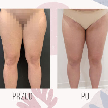 efekt przed i po odsysaniu tłuszczu z nóg