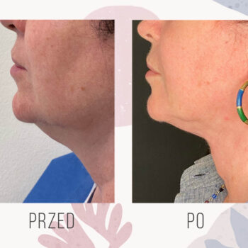 efekt po liposukcji podbródka