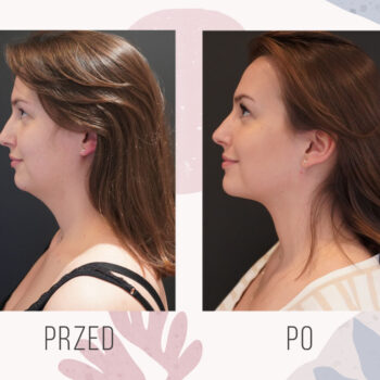 efekt przed i po liposukcji podbródka