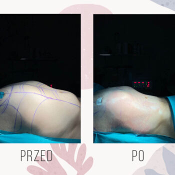 przed i bezpośrednio po zabiegu liposukcji