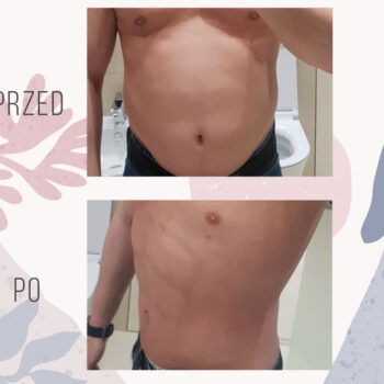 liposukcja vaser lipo brzucha