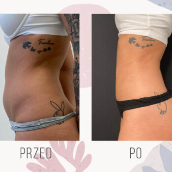 efekt po odsysaniu tłuszczu z brzucha