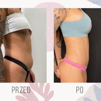 efekt wymodelowania brzucha