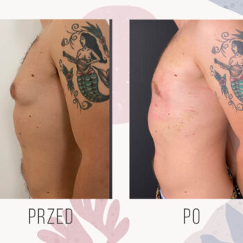 efekt po zabiegu leczenia ginekomastii