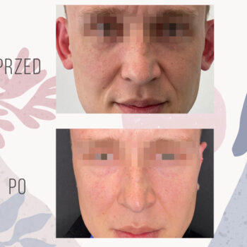 efekt korekt odstających uszu - przed i po