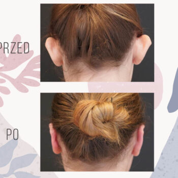 korekta uszu u kobiety