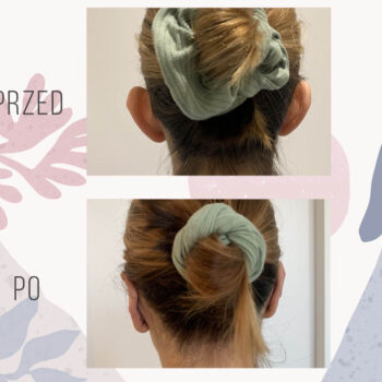 efekt po plastyce uszu