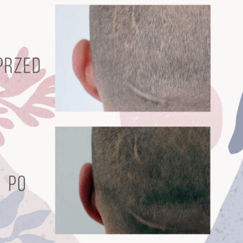 efekt przed i po zabiegu korekty odstających uszu