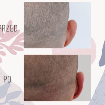 efekt przed i po zabiegu korekcji uszu