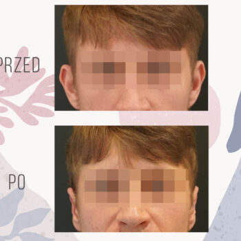 korekta uszu mezczyna