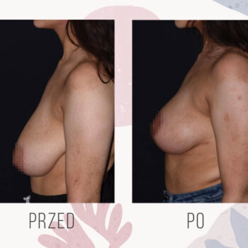 redukcja piersi i podniesienie piersi