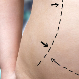 abdominoplastyka | OT.CO Clinic abdominoplastyka