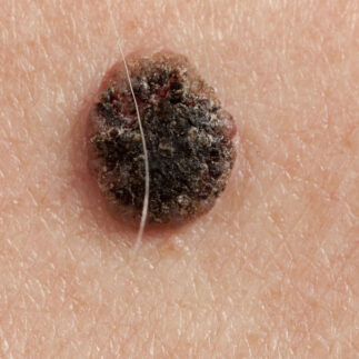 czerniak fakty i mity diagnostyka dermatologiczna | OT.CO Clinic czerniak fakty i mity diagnostyka dermatologiczna