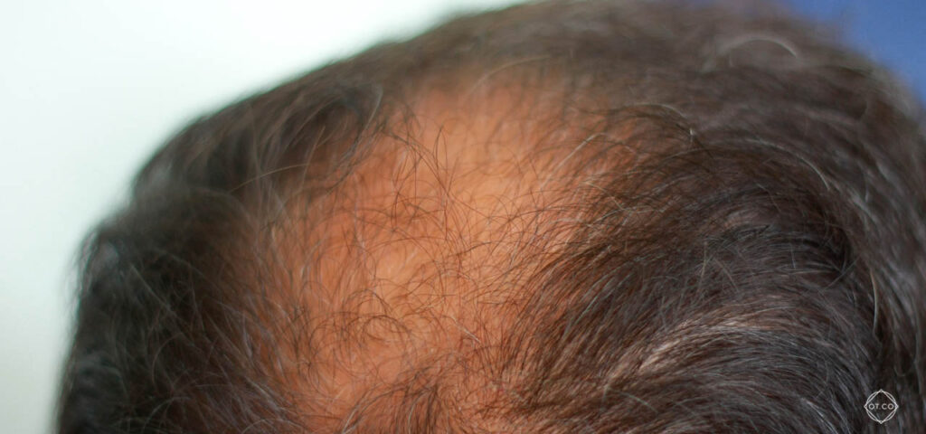 Androgenowe wypadanie włosów u mężczyzn