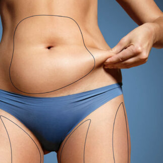 zgrany duet liposukcja vaser lipo i renuvion | OT.CO Clinic zgrany duet liposukcja vaser lipo i renuvion
