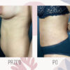 Plastyka Pow Ok Brzucha Abdominoplastyka Warszawa