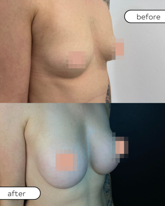 Rezultaty powiększania piersi implantami – porównanie wyglądu przed i po zabiegu
