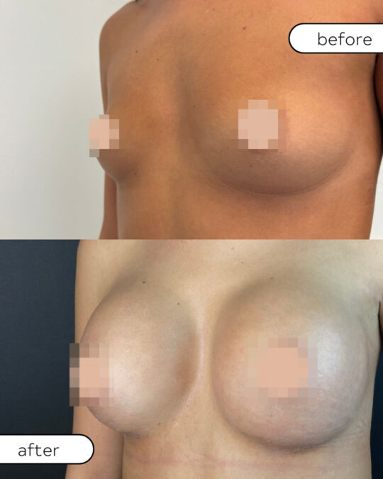Powiększanie piersi implantami – rezultat zabiegu, porównanie przed i po