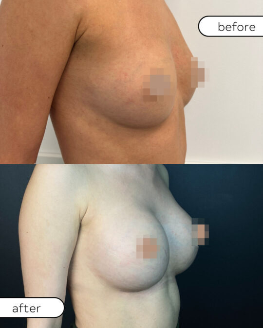 Powiększanie piersi implantami – efekt zabiegu widoczny z profilu, zdjęcia przed i po