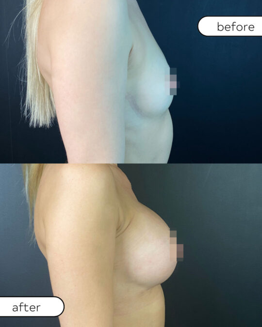 Efekty powiększania biustu implantami – zdjęcia przed i po z profilu