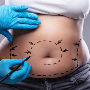 operacja plastyczna brzucha - abdominoplastyka