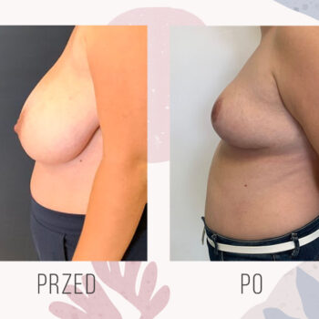 efekt podniesienia piersi po mastopeksji biustu