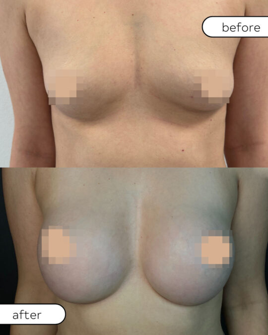Efekty powiększania piersi implantami – zdjęcia przed i po zabiegu