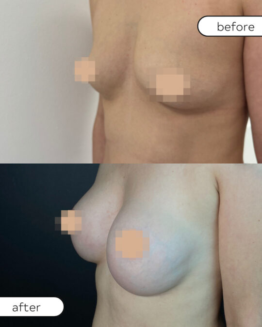 Efekty powiększania piersi implantami – zdjęcia przed i po z profilu