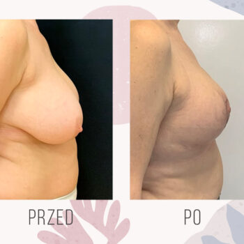 redukcja i podniesienie opadających piersi